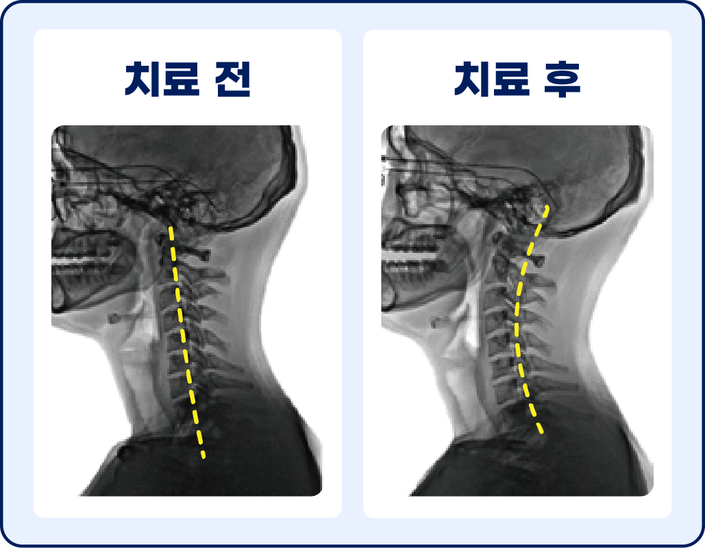 자세 교정 전/후